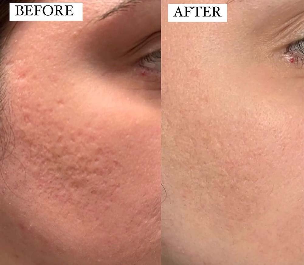 Micro-needling with Morpheus 8